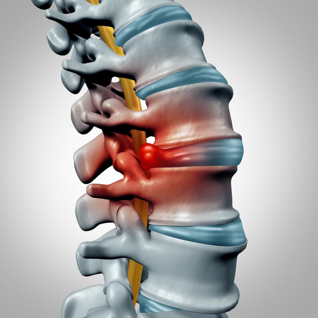 herniated-disc-workers-compensation